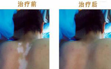 合肥白癜风患者恢复案例