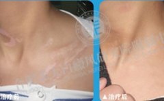 合肥白癜风患者恢复案例